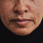 Máster en Cosmética para Hiperpigmentación y Melasma 2